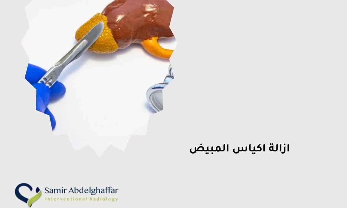 ازالة اكياس المبيض