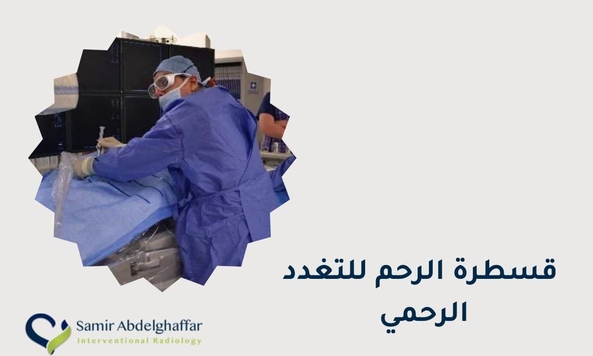 قسطرة الرحم للتغدد الرحمي مع الدكتور سمير عبد الغفار