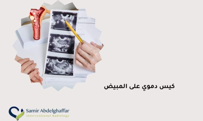 كيس دموي على المبيض