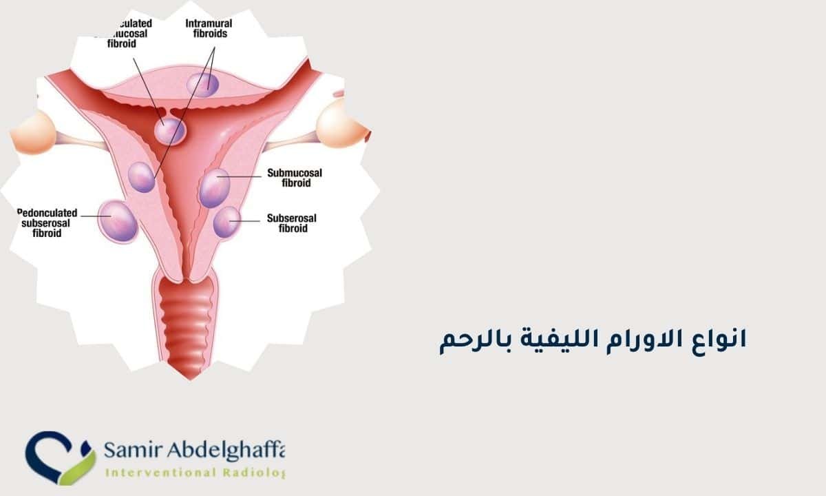 انواع الاورام الليفية بالرحم