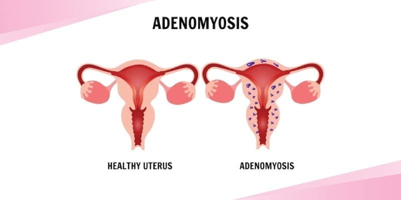 Adenomyosis.2