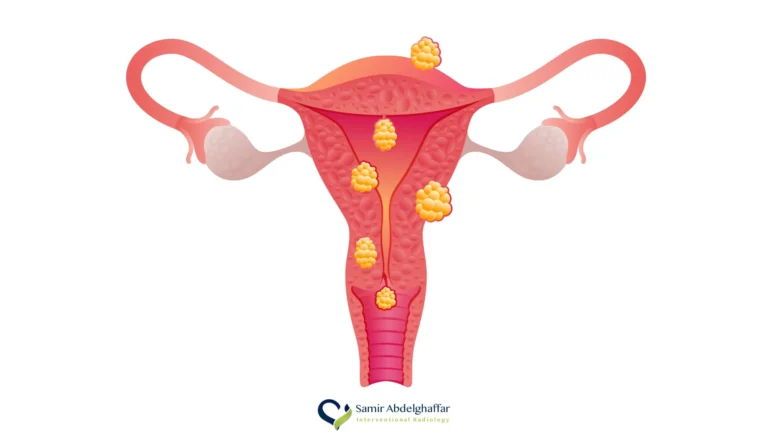 الورم الليفي في الرحم - متى يكون حجم الورم الليفي خطير